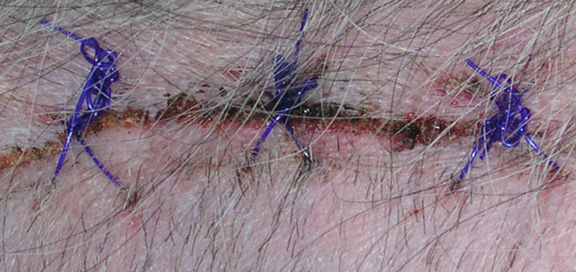 stitches